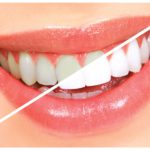 give dental encino whitening
