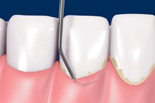 Give Dental - Deep Cleaning - Below the Gum Line