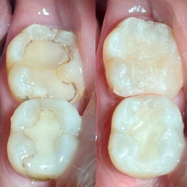Fillings (Before and After)