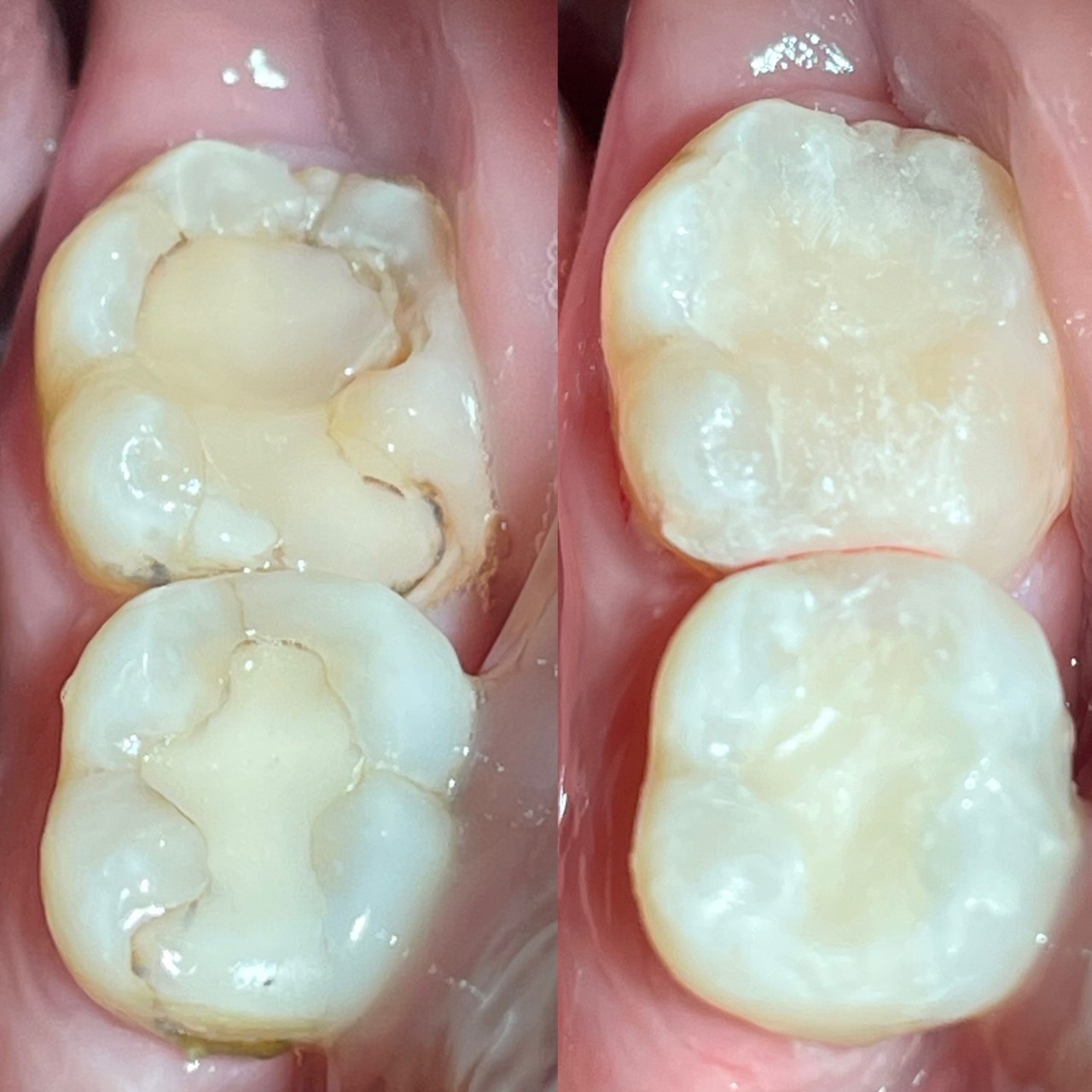 Give Dental - tooth filling before and after image