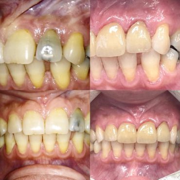 Replace missing teeth (Before and After)
