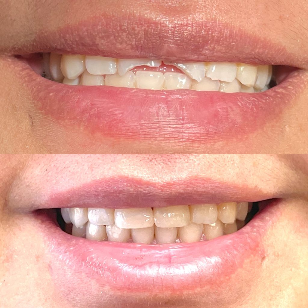 Give Dental - Before and after same day treatment chipped teeth