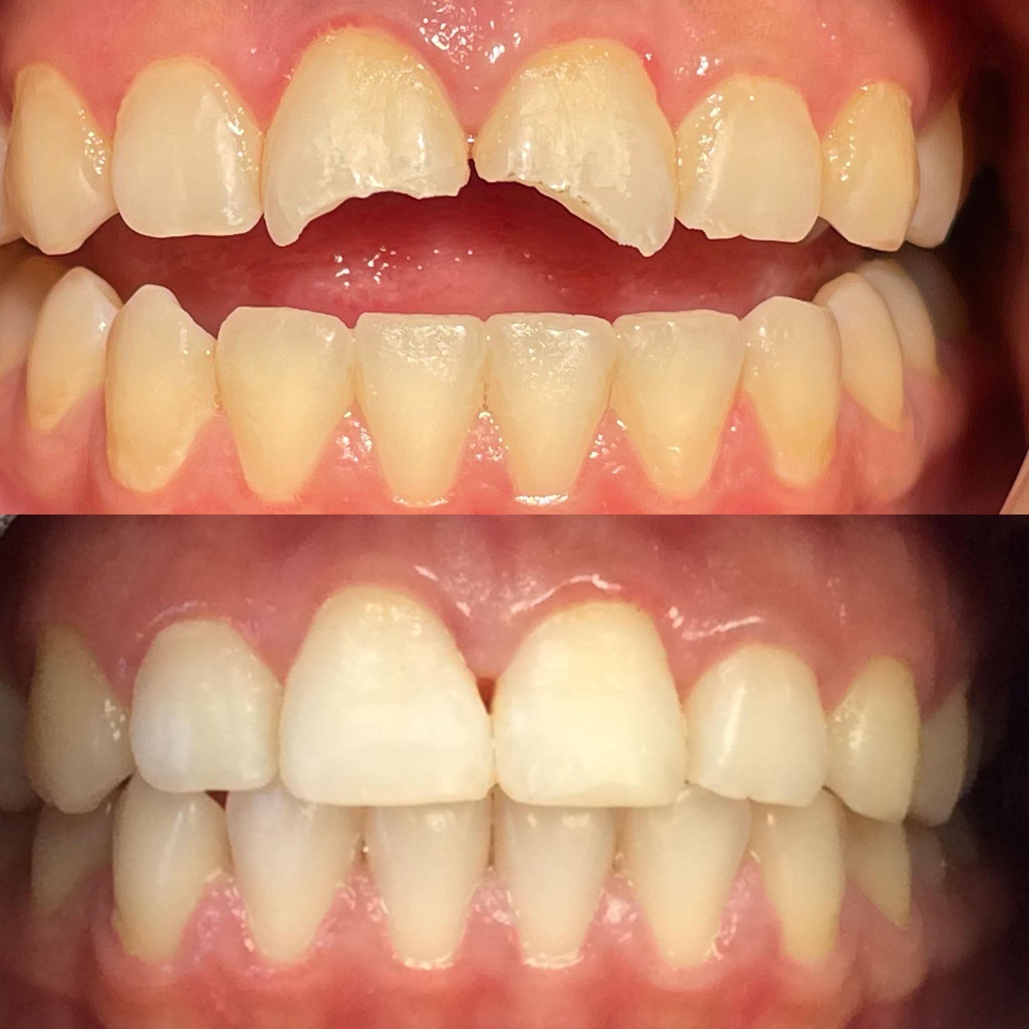 Give Dental Composite filling for chipped teeth (add same day emergency treatment)