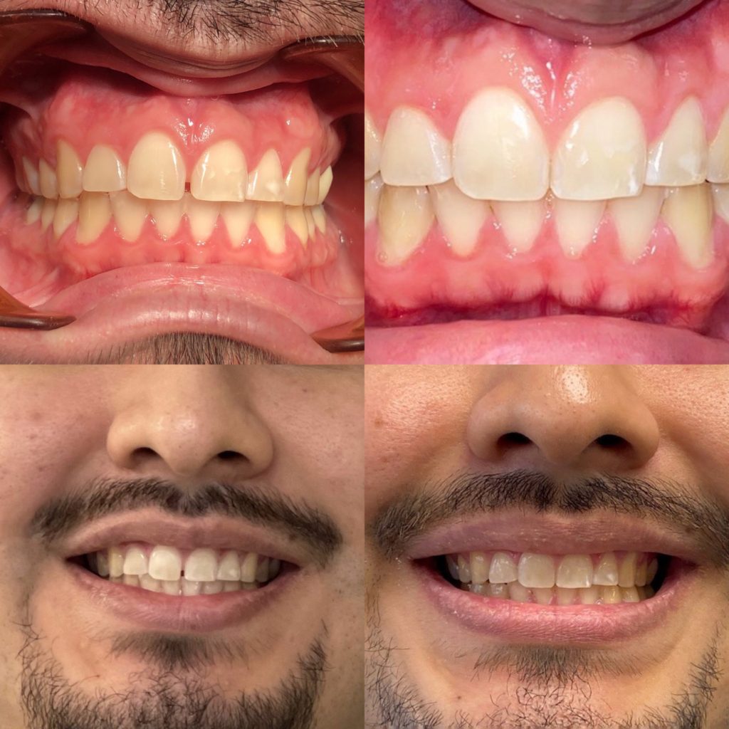 Give Dental - Male Patient - Invisalign before and after