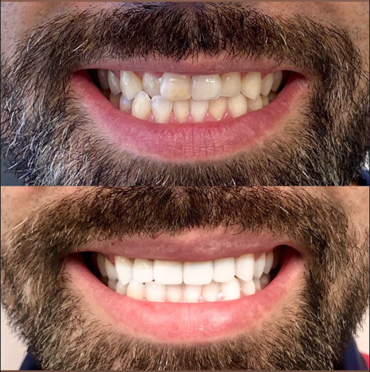 Give Dental - Male Patient - Veneers + Whitening
