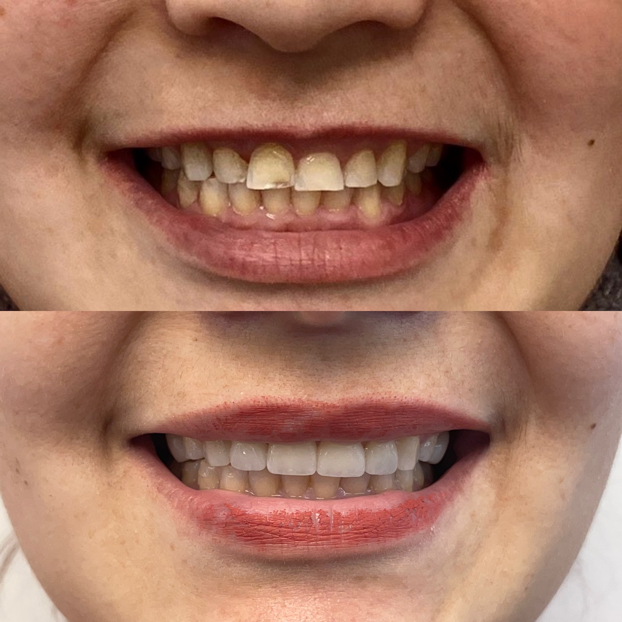 Give Dental - Woman Patient - Veneers before and after