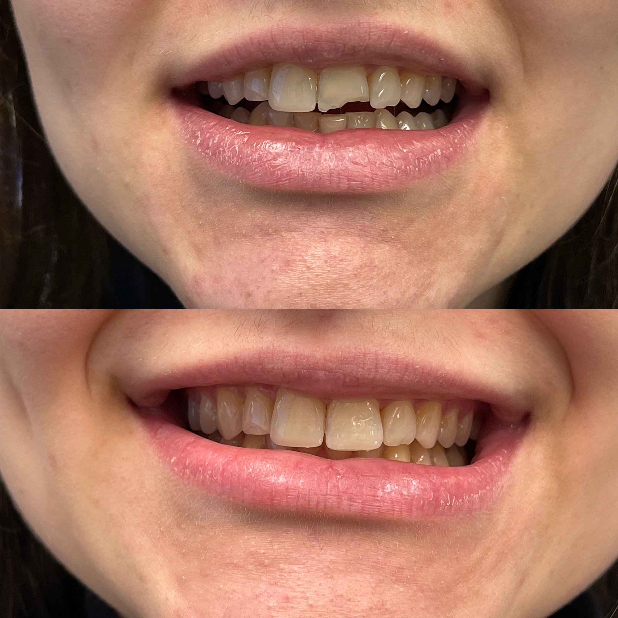 Give Dental - Woman Patient - Composite before and after