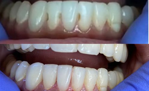 Fillings (before and after broken chipped teeth)