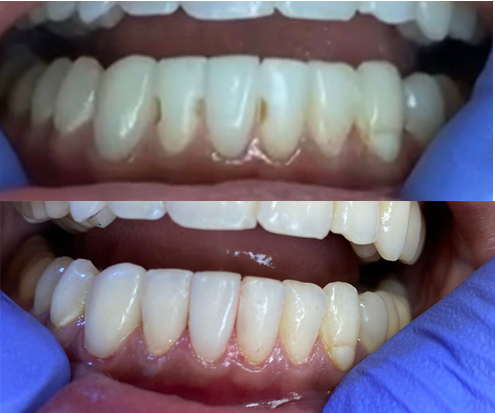 Give Dental - before and after broken chipped teeth