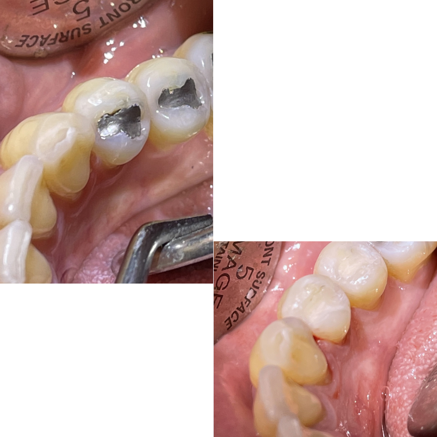 Give Dental Patient - silver filling before and after