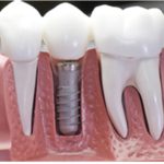 give dental encino implants