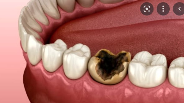 Give Dental -Severely Decayed Tooth image