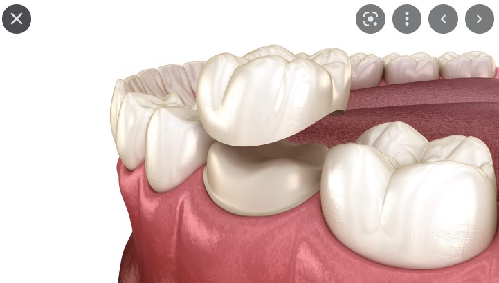 Give Dental - Decay Removed, Crown Placed