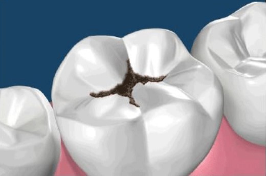 Give Dental - Decaying Tooth Image