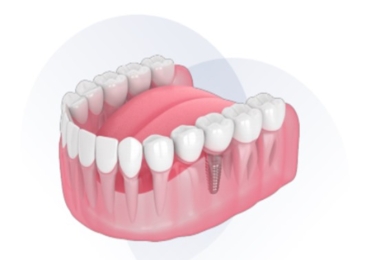 Give Dental - Completed Dental Implant