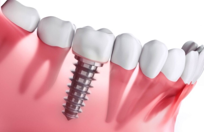 Give Dental - Dental Implant