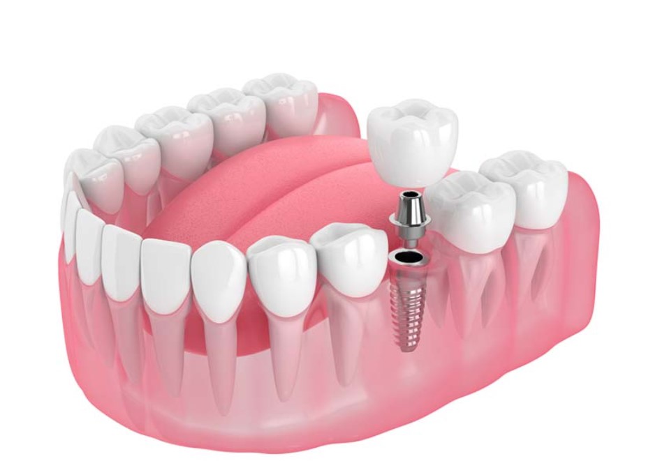Give Dental - Placing Dental Implant with Crown