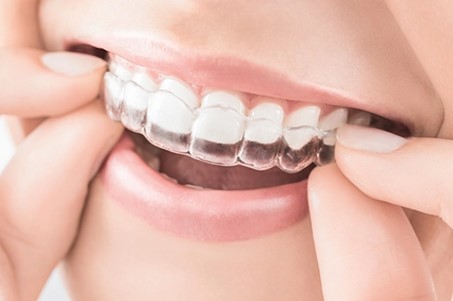 Give Dental - Invisalign Upper Tray