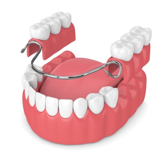Give Dental - Partial Denture image
