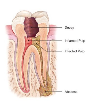Give Dental - Root Canal Diagram