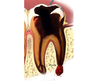 Give Dental - Severely Decayed Tooth Diagram