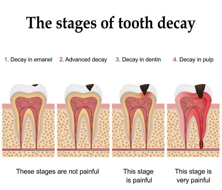 Give Dental - Stages of Tooth Decay Image