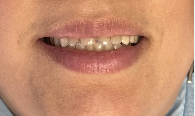 Give Dental Patient - Stained and Chipped Front Teeth Image