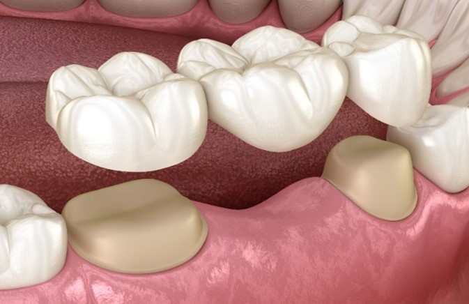Give Dental - Dental Bridge