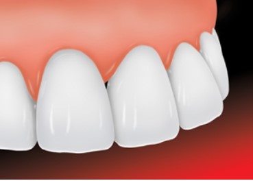 Give Dental - Veneer, Bonded to Tooth