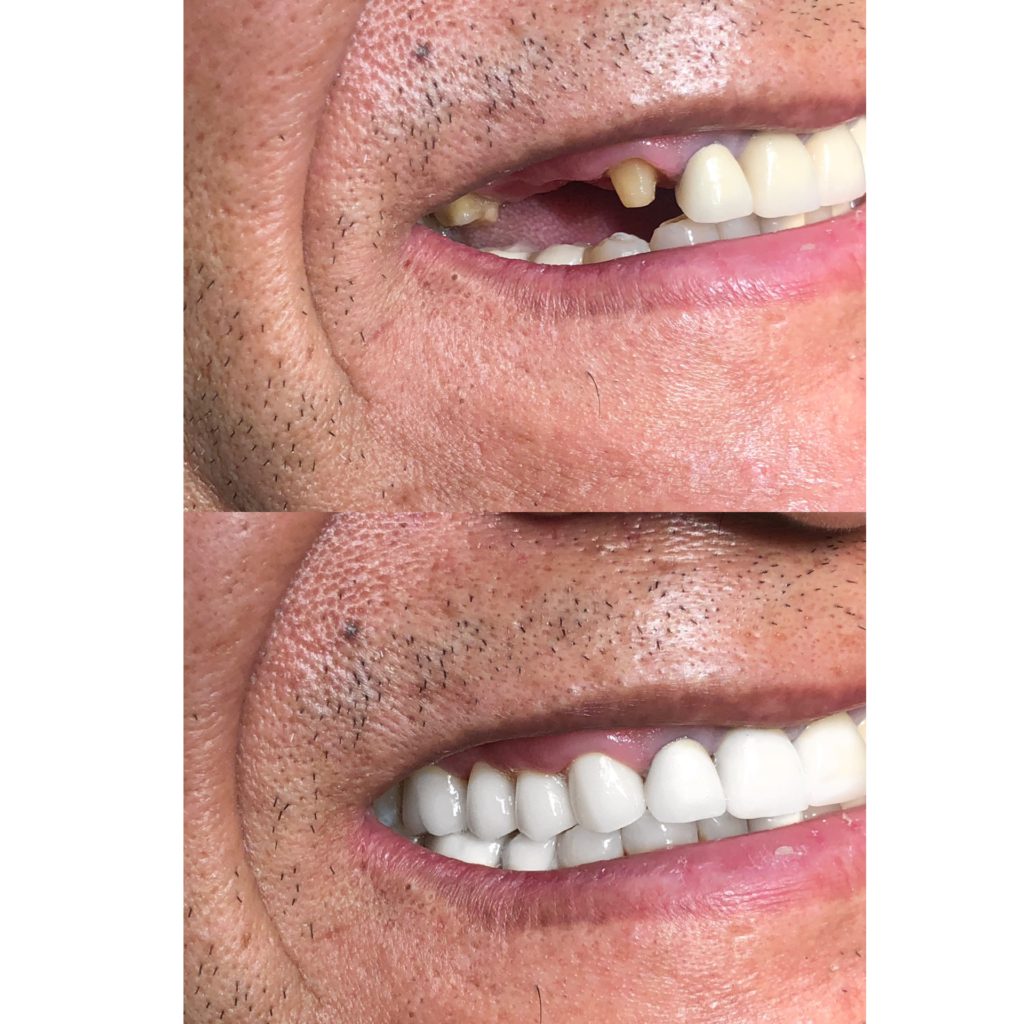 Give Dental Patient Before and After Bridge
