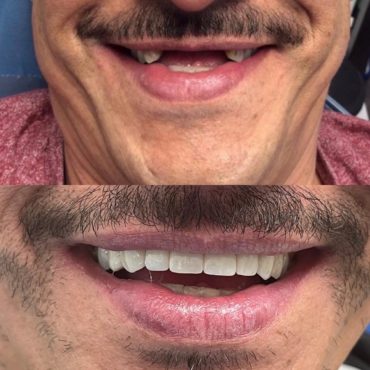 Bridge (Before and after missing teeth)