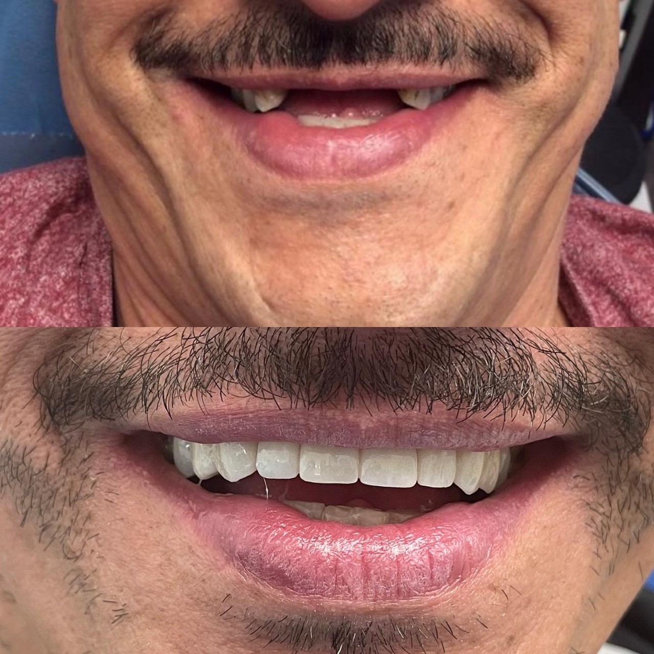 Give Dental patient Before and After Missing Teeth