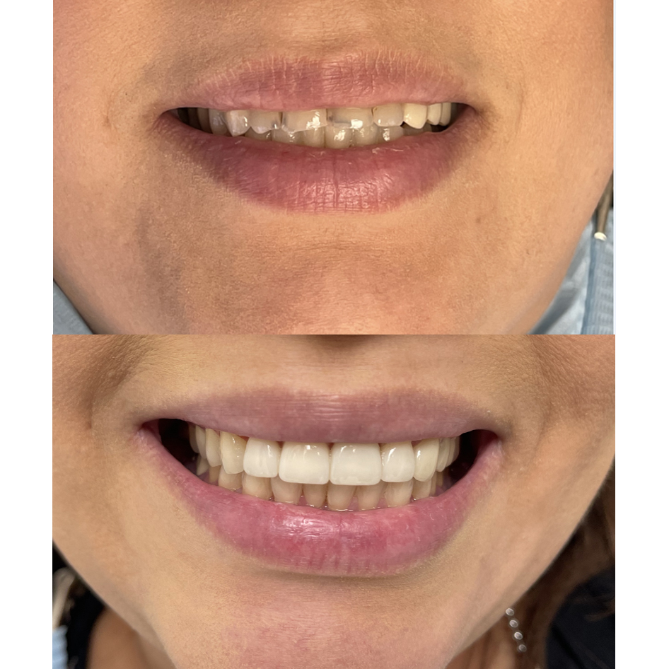 Give Dental patient Veneers before and after