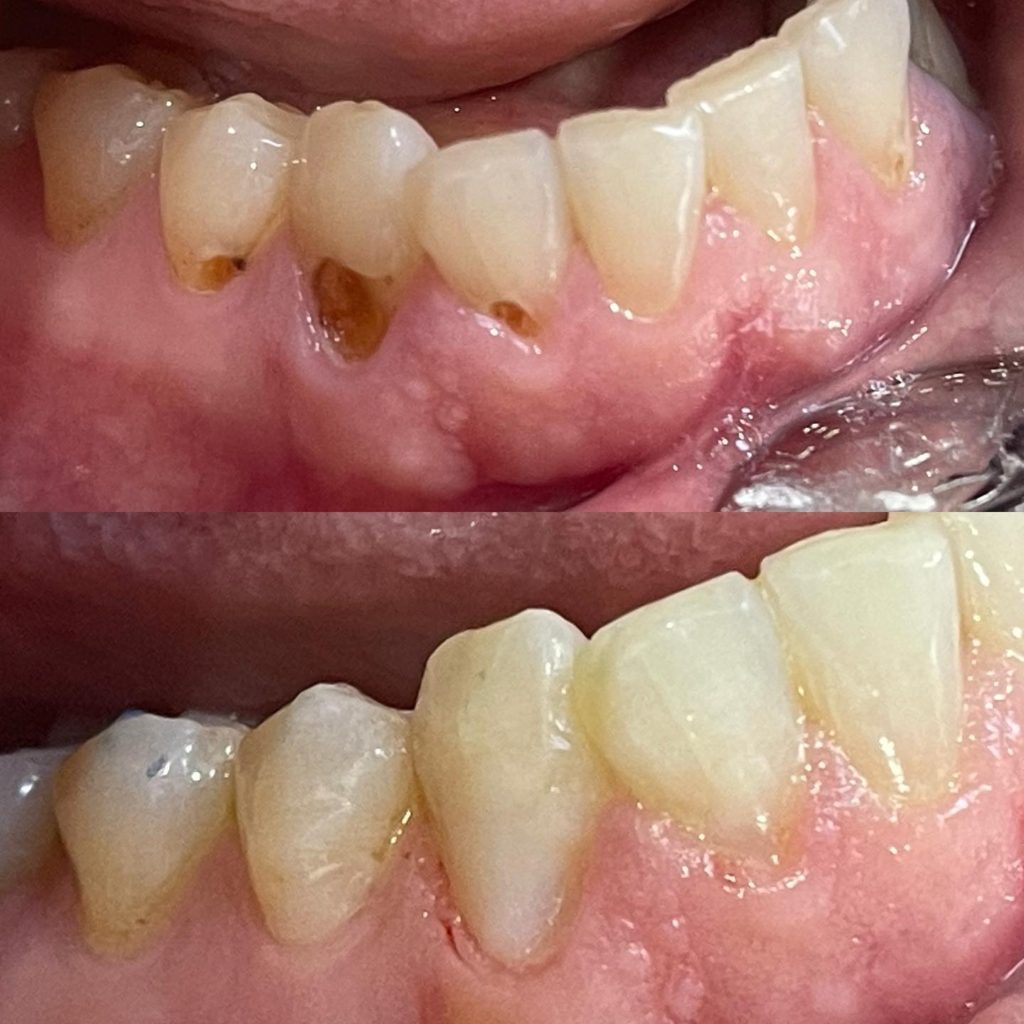 3 Cavity Fillings before and after