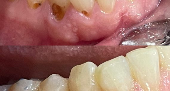 3 Cavity Fillings (before and after)