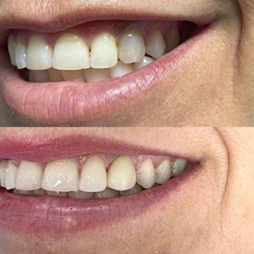 Crown and discolored tooth (before and after)