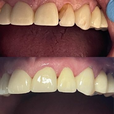 Crown before and after (Chipped tooth)