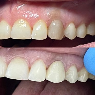 Crown with discolored tooth (before and after)