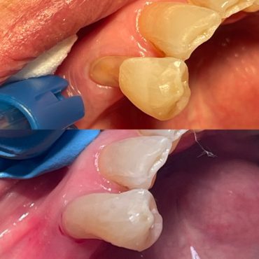 Fillings before and after (yellow to white)