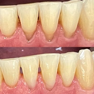 Fillings before and after (Straight Teeth)