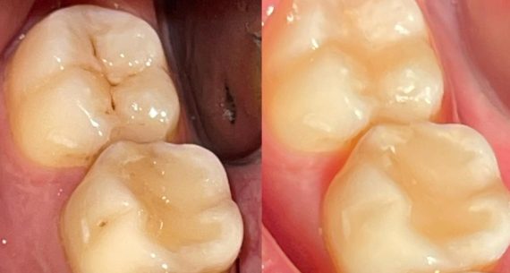 Three back teeth White Fillings (before and after)