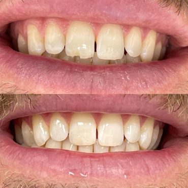 Filings (chipped tooth) before and after