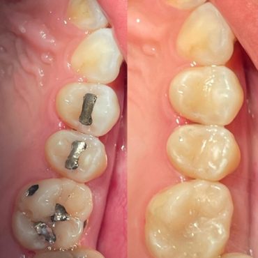 Silver Fillings to White (before and after)