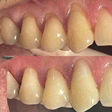 Three Fillings (before and after)