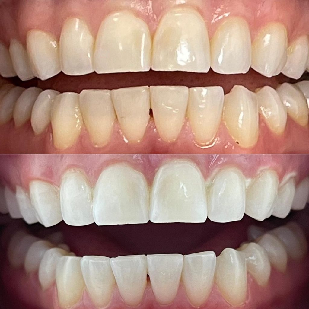 Whitening staight teeth (before and after)