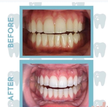 Whitening straight teeth (before and after)